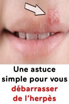 astuce pour herpès 2899528783402700458..jpg